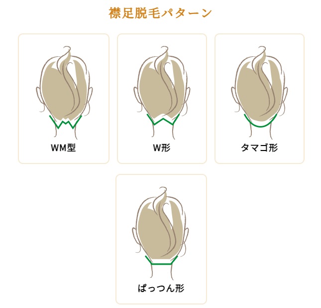 ルシアクリニックでは襟足のデザイン脱毛が可能です。WH形・W形・タマゴ形・ぱっつん形から選べます。